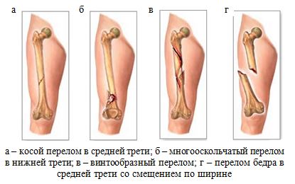 Реферат: Закрытый косой диафизарный перелом левой бедренной кости на границе средней и нижней трети со